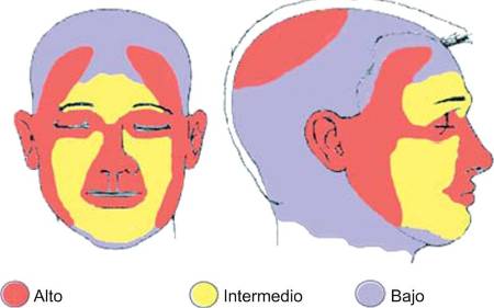 Localizaciones del carcinoma basocelular