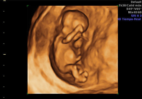 Ecografía 4d del primer trimestre