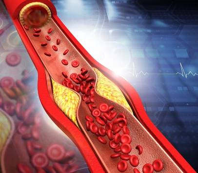 ¿Angina de pecho o infarto? Aprende a distinguirlos