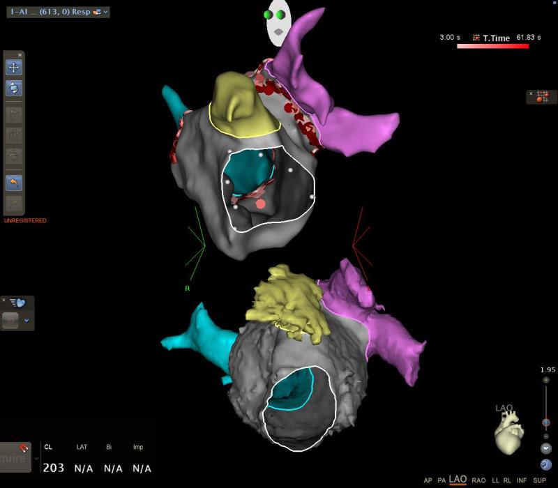 Un sistema tipo GPS para localizar y tratar las arritmias