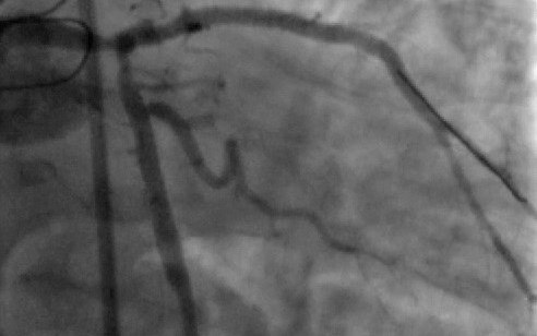 Aterectomia rotacional