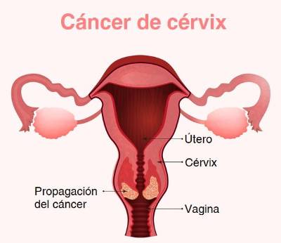 Cáncer cervical, ¿dónde se ubica?