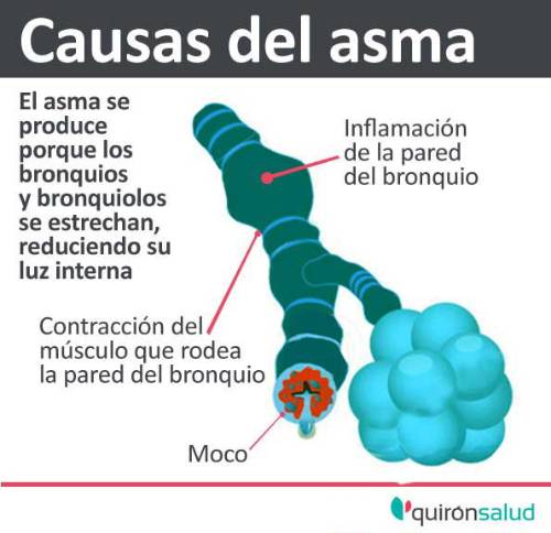 Causas del asma