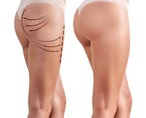 Cirugía de aumento de glúteos