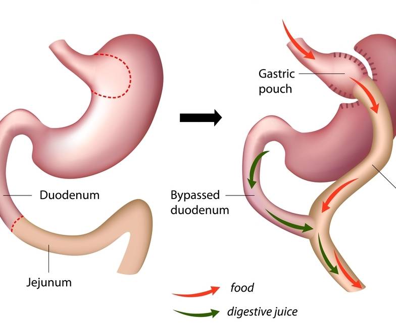 Cirugía bariatrica contra la diabetes