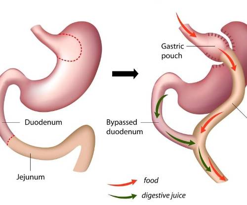 Cirugía bariatrica contra la diabetes