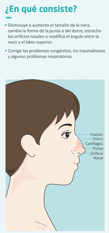 En qué consiste la cirugía de nariz o rinoplastia