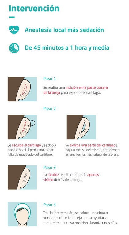 Cirugía de la otoplastia: cómo se realiza