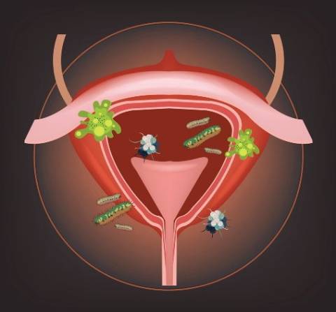 La cistitis y otras infecciones