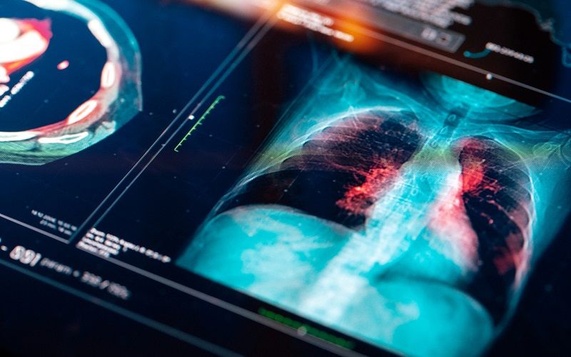 Crioablación para tratar el cáncer con frío