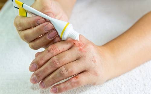 Dermatitis en las manos