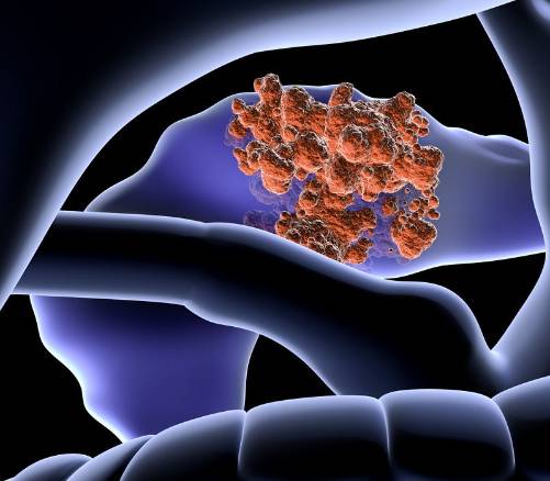 Relación entre diabetes y cáncer de páncreas