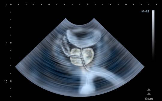 Ecografía de próstata