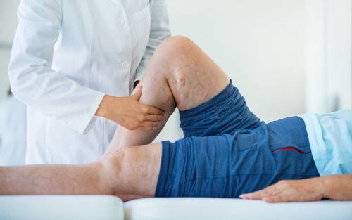 Cómo eliminar las varices sin cirugía