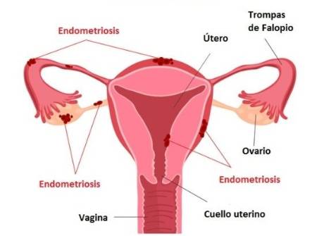 La endometriosis puede afectar a la fertilidad de la mujer