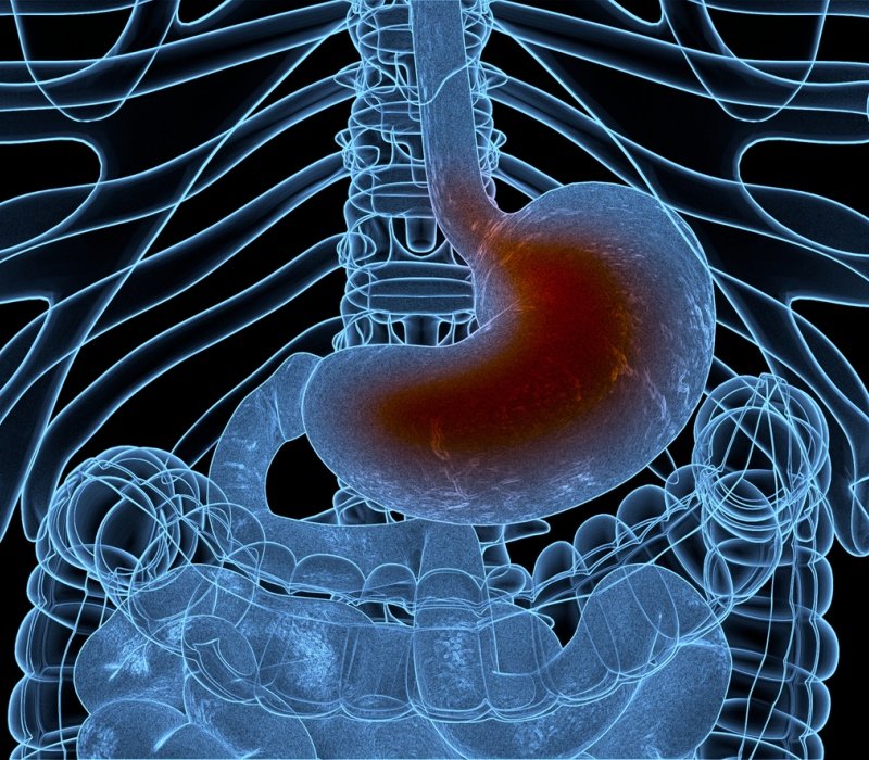 Enfermedad de reflujo gastroesofágico