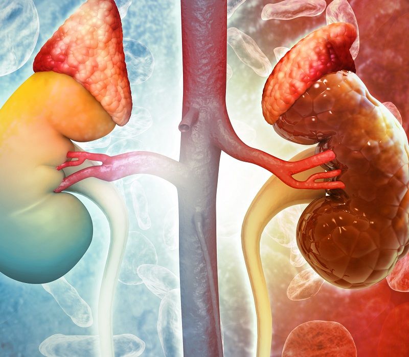 Enfermedad renal crónica: qué es y cómo prevenirla