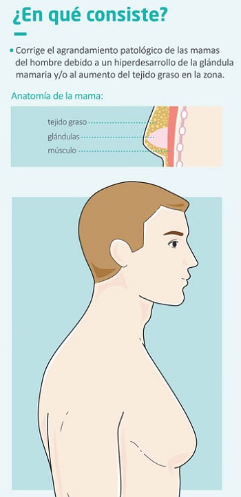 Ginecomastia en hombres: qué es