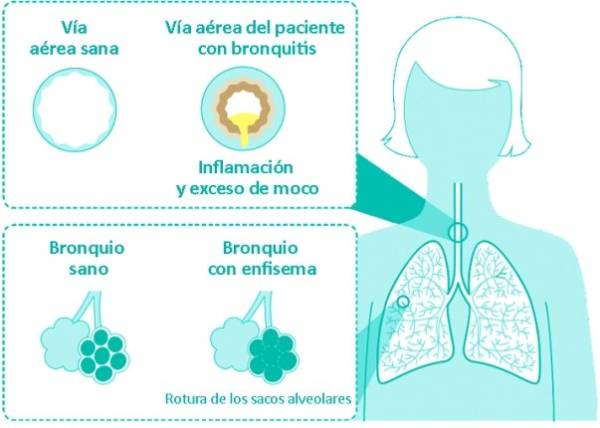 Gráfico sobre la EPOC