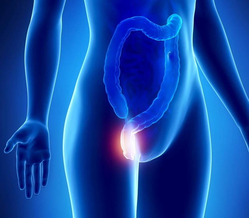 Hemorroides y sus síntomas