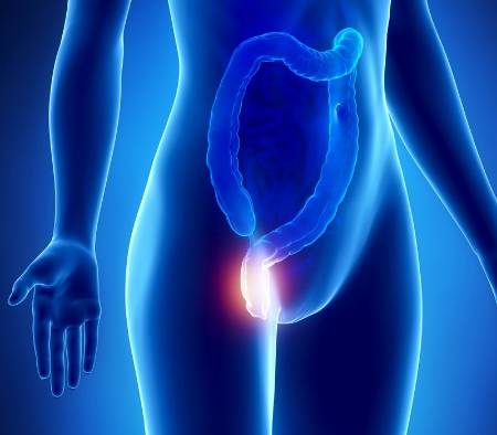 Hemorroides y sus síntomas