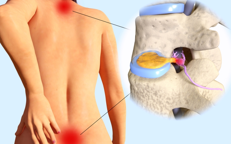 Hernia de disco y neuroendoscopia