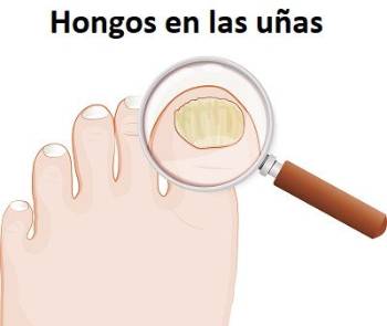 Hongos en las uñas o pies de atleta