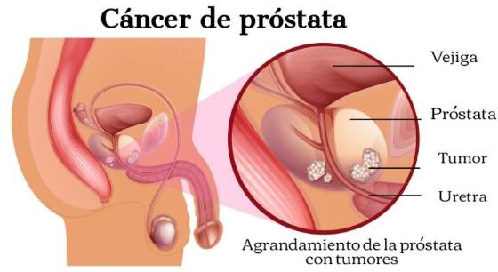 Ilustración del cáncer de próstata