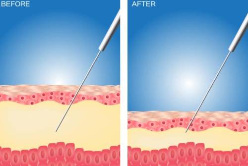 Liposucción Bodyjet