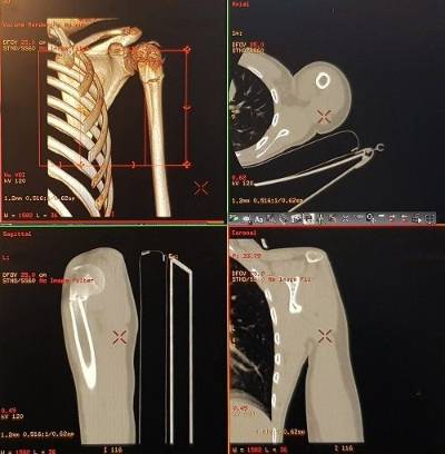 Ejemplo de imágenes tridimensionales obtenidas a través del TAC