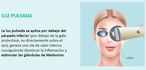 Infografía del tratamiento de luz pulsada para el ojo seco