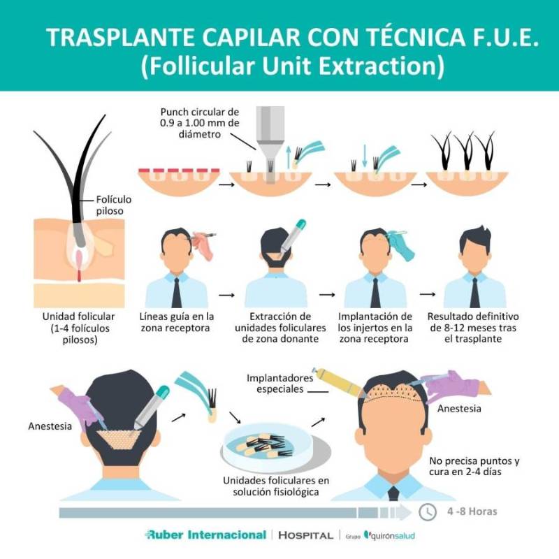 Infografía de la técnica FUE capilar, paso a paso