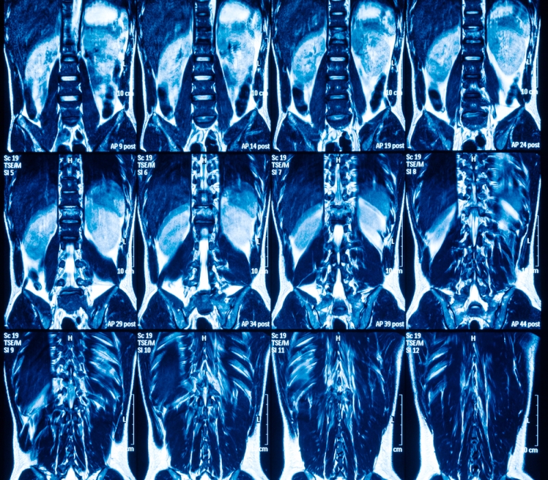 Innovacion en cirugía de columna