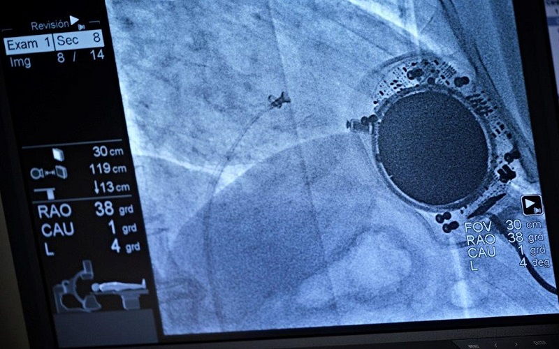 Marcapasos sin cables: qué es y cómo se coloca