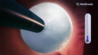 Crioablación: la cirugía que trata la fibrilación auricular con frío