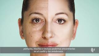 Melasma: qué es y su diagnóstico