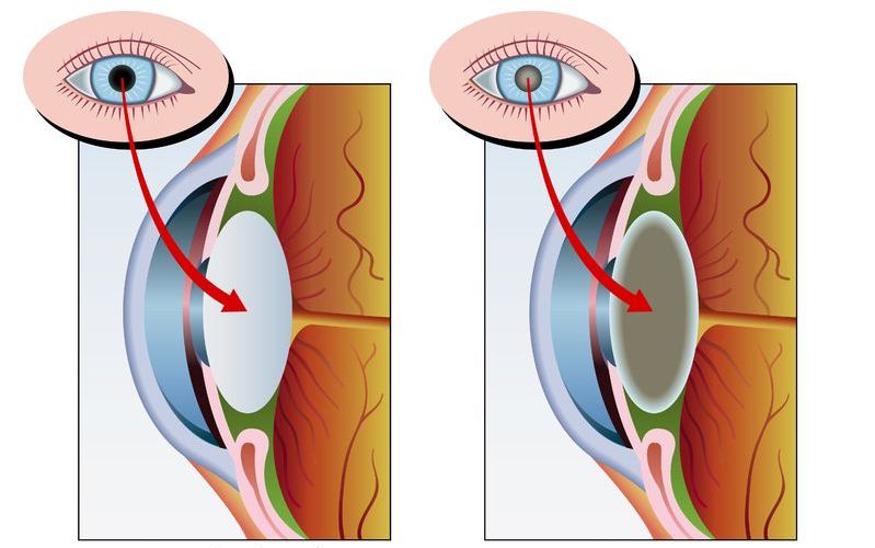 Esquema de un ojo sano (izda) y con catarata (dcha)