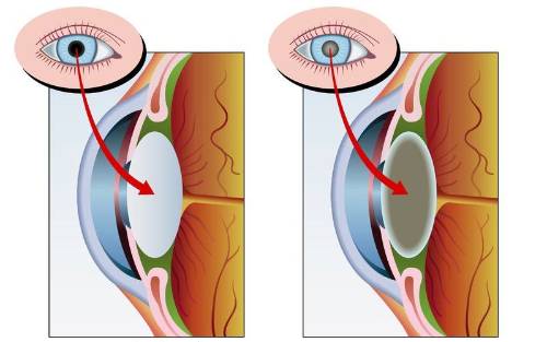 Esquema de un ojo sano (izda) y con catarata (dcha)