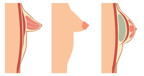 Pecho tuberoso, antes y después de la cirugía