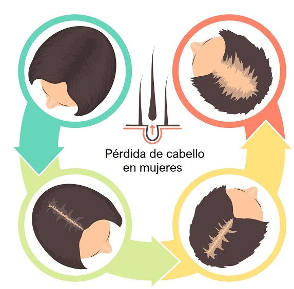 Patrón de pérdida de cabello en la mujer