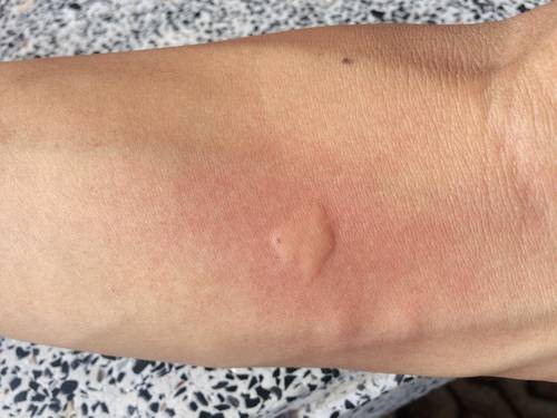 Imagen de una picadura de mosquito
