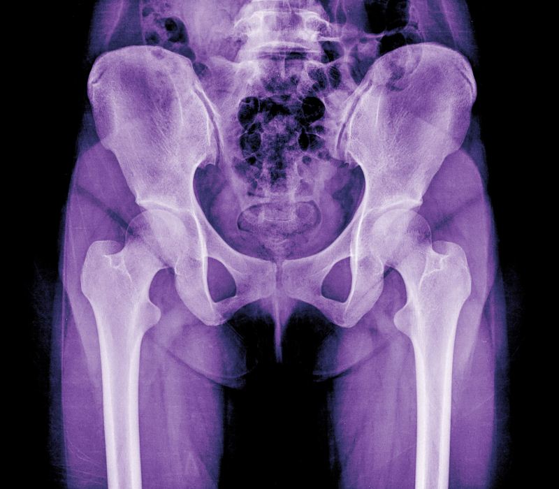 prevenir la protesis de cadera