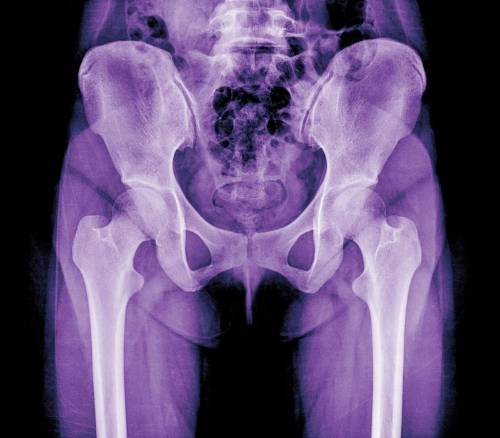 prevenir la protesis de cadera