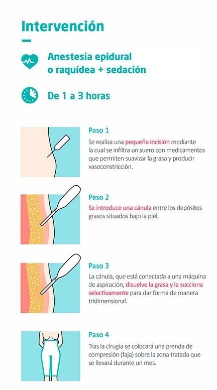 Infografía sobre cómo se realiza la lipoescultura