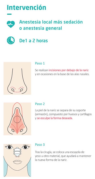 Intervención de la rinoplastia