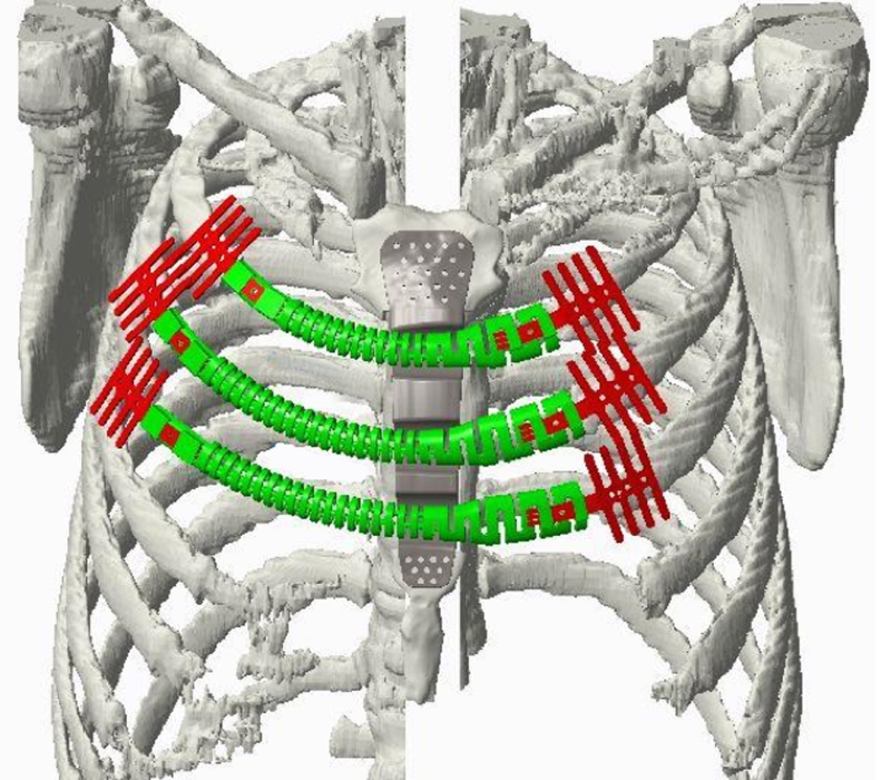 Prótesis de titano por impresion en 3D
