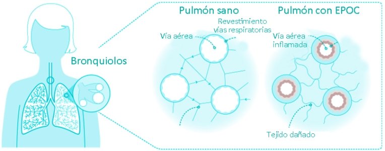 Pulmón sano y pulmón con EPOC