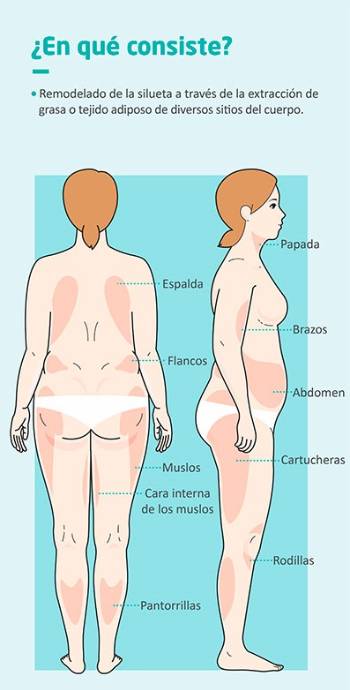 Zonas donde se aplica la lipoescultura