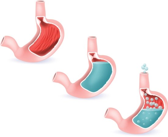 Estómago con reflujo gastroesofágico