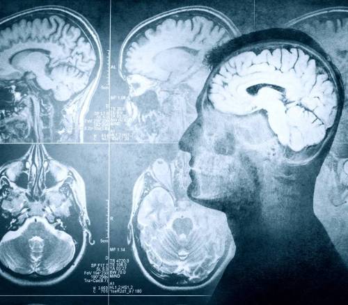 Relación entre fibrilación auricular